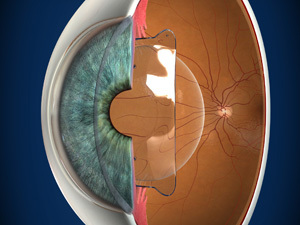 Clínica Oftalmologia Orduna. Expertos en Cirugía Ocular y Refractiva. Pioneros en tratamientos Láser y Fotobiomodulación Láser Miodesopsias-Moscas volantes - Cirugía refractiva con (ICL)